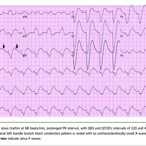 Initial 12 Lead Electrocardiogram Download Scientific Diagram
