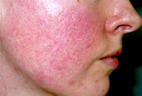 Types Of Rosacea On Face Symptoms And Treatments The Natural Cure