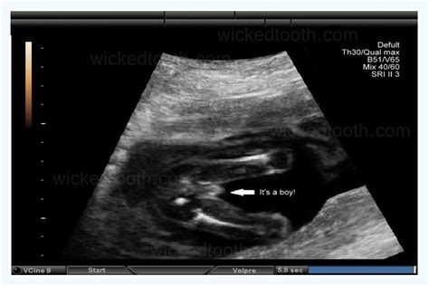 Its A Boy Gender Reveal Prank Ultrasound Si35 Other