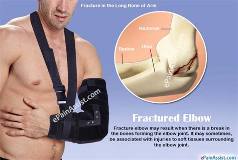 Fractured Elbowcausessymptomstreatmentrecoveryphysical Therapy