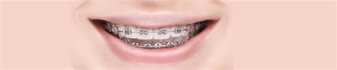 Train Track Braces Fixed Braces For Kids Whitetree Orthodontic Centre