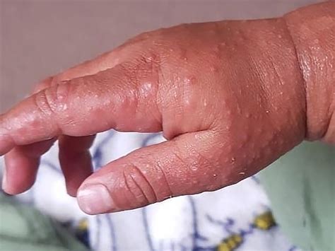 Hand Foot And Mouth Disease Babycenter