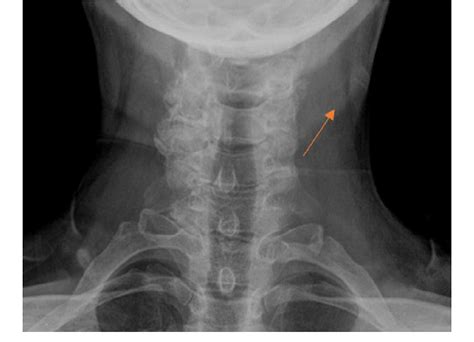 Soft Tissue Neck Radiograph Showing Thickening Soft Tissue Shadow