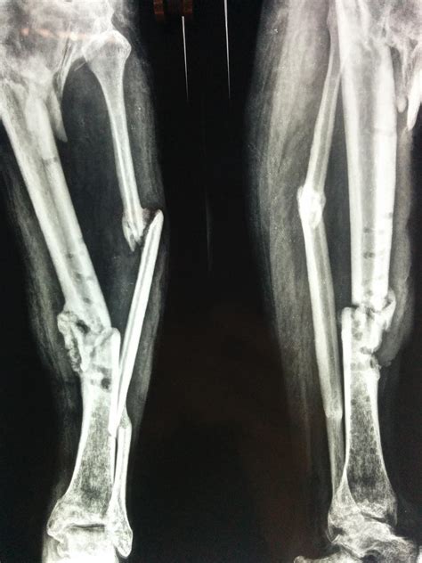 Tibial Fractures Images