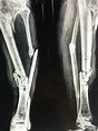 Tibia Shaft Fractures - Trauma - Orthobullets.com
