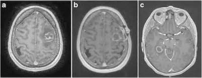 Progressive Cerebral Toxoplasmosis On Interval Neuroimaging Serial