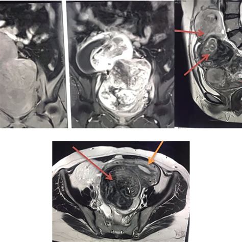 A Lower Transverse Incision B Lower Transverse Incision At A