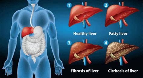 Liver Cirrhosis Causes Symptoms Types Stages Treatment