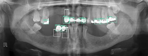 How To Identify Dental Implants By X Ray Dental News Network