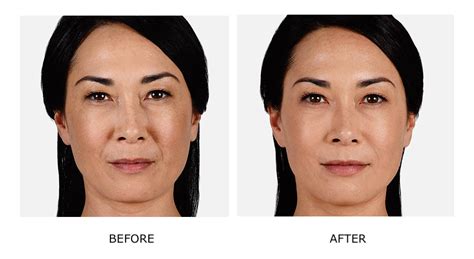 Juvéderm For Lost Facial Volume Duluth Atlanta Wow Medi Spa