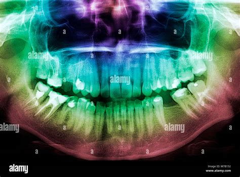 Close Up Of A Dental X Ray Stock Photo Alamy