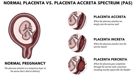 Placental Problems During Pregnancy And Management