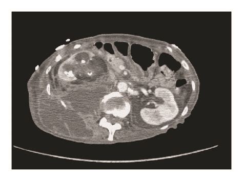 Axial Section Of A Ct Scan Of The Abdomenpelvis With Iv Contrast