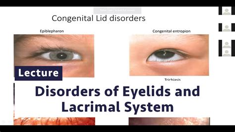 Disorders Of Eyelids And Lacrimal System Youtube