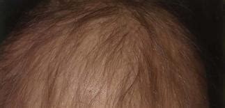 Hair loss, hair thinning and problems with hair growth may occur when your growth cycle is disrupted. Telogen and anagen effluvium | Plastic Surgery Key
