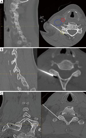 CT Guided Radiofrequency Ablation Of The Cervical Medial Branch Using A