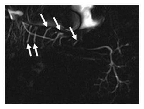 Ducts Of Rivinus Crossing The Main Submandibular Gland Duct Vertically