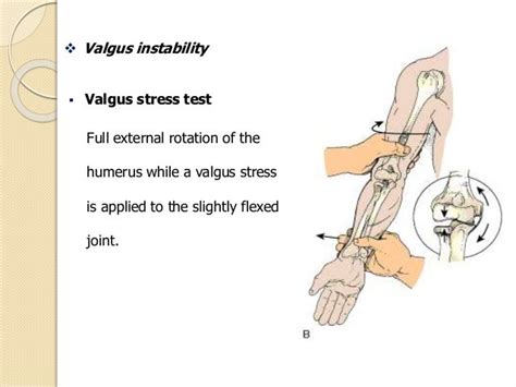 Management Of Chronic Elbow Instability 13