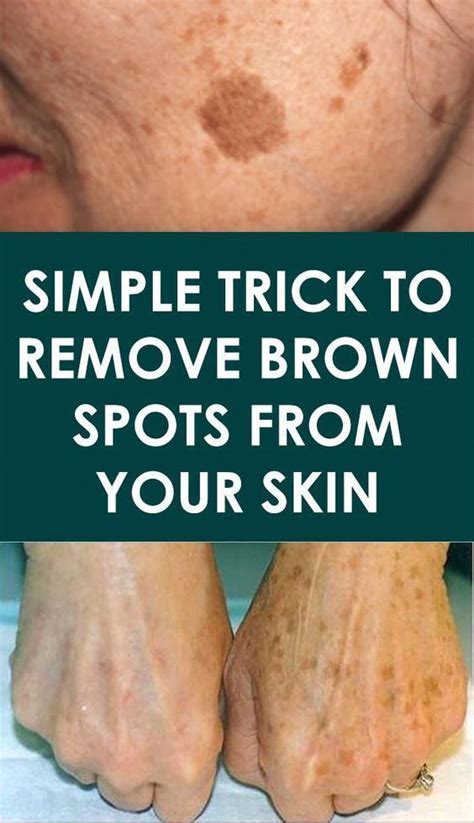 Ways To Get Rid Of Brown Spots On Face Creamforbrownspotsonface