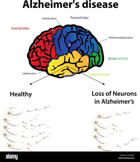 Alzheimers Disease Stock Vector Image And Art Alamy