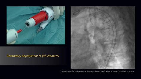 Resource Library For Gore Tag Conformable Thoracic Stent Graft With