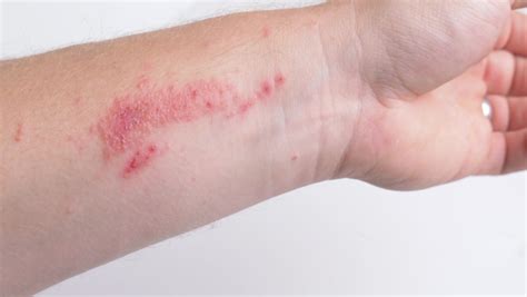 Poison Ivy Rash On Arm Scratching Stock Footage Video 100 Royalty