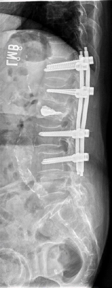 Radiographic Findings Of The Lumbar Spine A Plain Radiogram Of Lumbar My XXX Hot Girl
