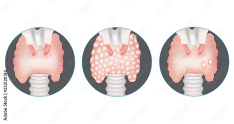 Thyroid Gland Diseases Healthy Thyroid Multinodular Goiter And Gland