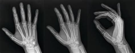 It also can detect broken bones or dislocated joints. Top 60 Hand X Ray Stock Photos, Pictures, and Images - iStock