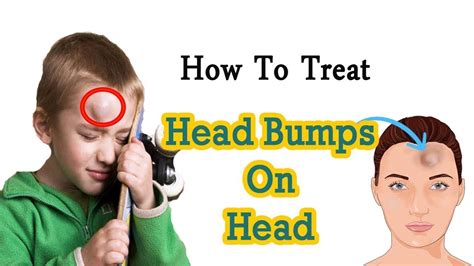 How To Get Rid Of Head Bump Naturally At Home Home Remedies For Head Bump Goose Egg Youtube