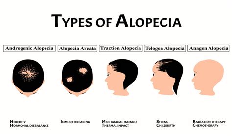 Causes Of Alopecia Dr Batras