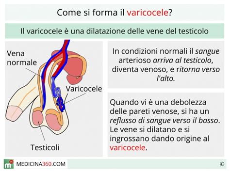 Varicocele Sintomi Cause Gradi Diagnosi Cura E Operazione Hot Sex Picture