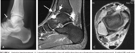 Figure From Imaging Of Impingement Lesions In The Ankle Semantic My Xxx Hot Girl