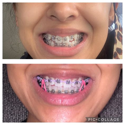 45 Month Update My Ortho Is Very Surprised And Happy With My Progress