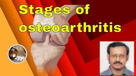 Osteoarthritis Stages Of Osteoarthritis And Treatment In Homeopathy
