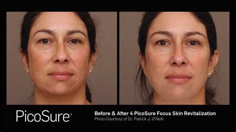 Picosure Laser Charleston Sc Oneill Plastic Surgery