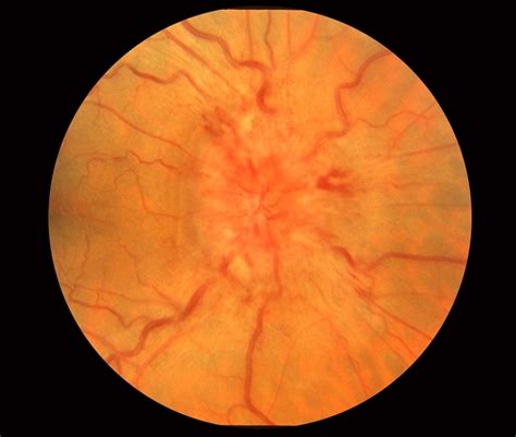 Optic Disc Edema And Hemorrhages With Subdural Hematoma Retina Image Bank