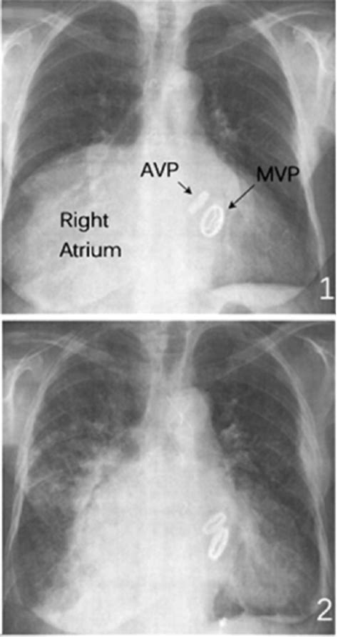 Ap Chest Xray With Aortic Valve Replacement Clinical