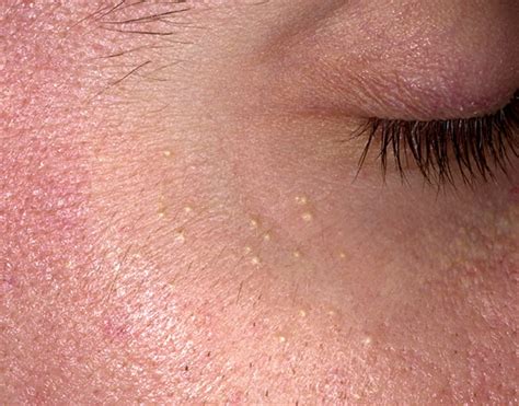 Small Bumps On Face Milia Dorothee Padraig South West Skin Health Care