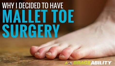 Mallet Toe Surgery Exercises For Curled Toes And Post Op Recovery