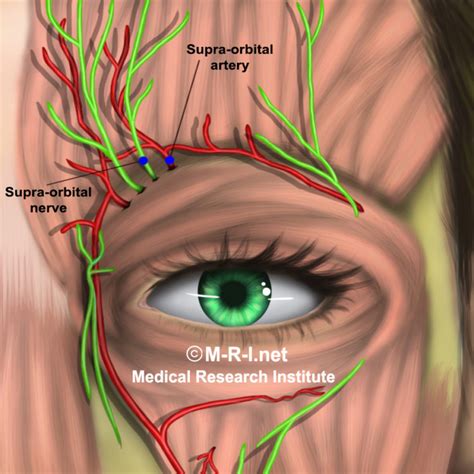 Supraorbital Infraorbital Nerve Blocks For Migraine 6 Months Follow