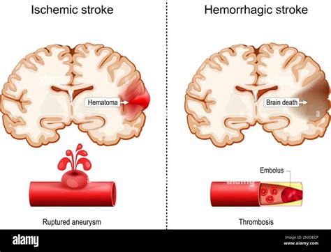 Hemorrhagic And Ischemic Strokes Cross Sections Of Human Brain With