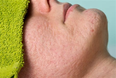 Open Pores Types Causes Symptoms And Medical Treatment