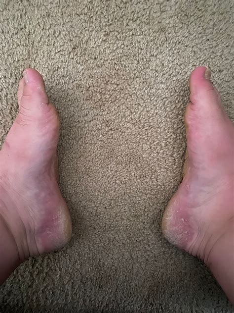 Nasty Dry Feet Pics Etsy