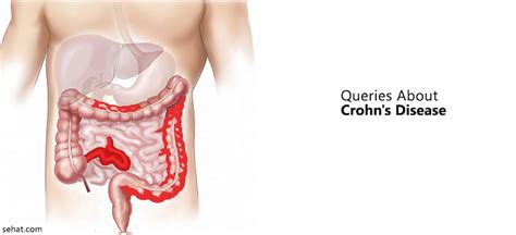 Questions That You Need To Ask Your Doctor About Crohns Disease Sehat