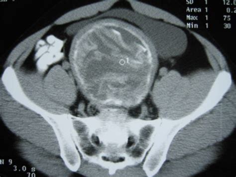 Corte Tomográfico Axial Do Abdome Inferior Evidenciando Massa