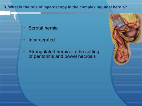 Laparoscopic Inguinal Hernia Surgery Anatomy