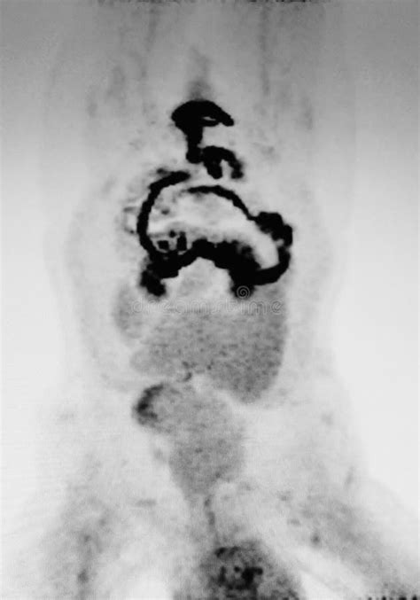 Ct Scan Ascites Peritoneal Carcinoma Stock Photo Image Of Abdominal