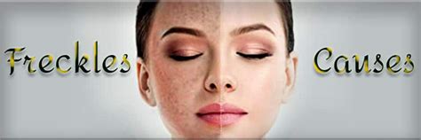 Freckles Causes And Preventing Methods Of Them Oxxo