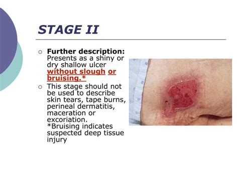 Ppt Pressure Ulcer Staging Powerpoint Presentation Id6113428